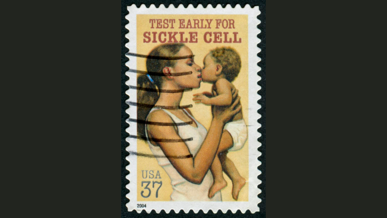sickle cell disease history Cancelled Stamp From The United States Featuring An Appeal For Early Testing For Sickle Cell. Credit: Rarediseaseadvisor.com
