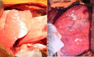 Image shows the pig lung right after it was transplanted and four days later.