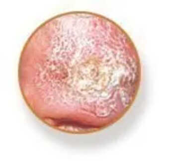 Squamous Cell Carcinoma