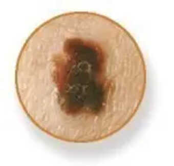Melanoma
