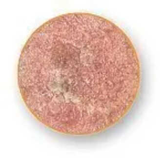 Actinic Keratoses