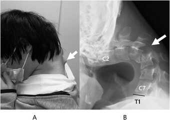 Lateral view of the patient&#39;s head and neck at the first visit showing chin-on-chest position
