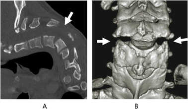 CT of the cervical spine