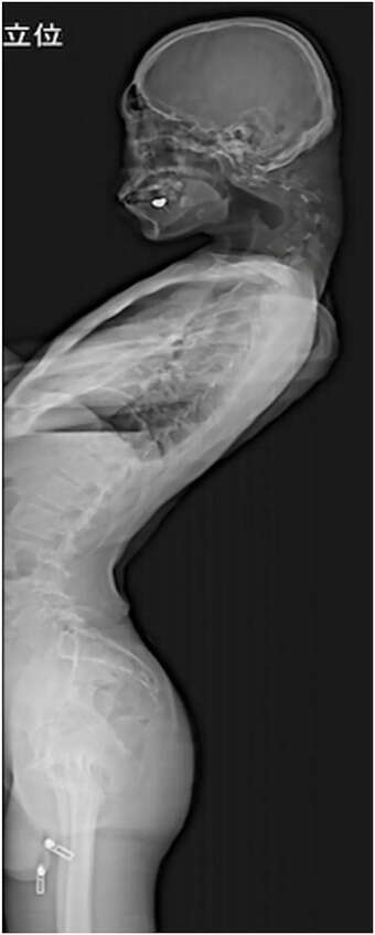 Preoperative standing lateral radiograph of the whole spine exhibiting significant lumbar hyperextension