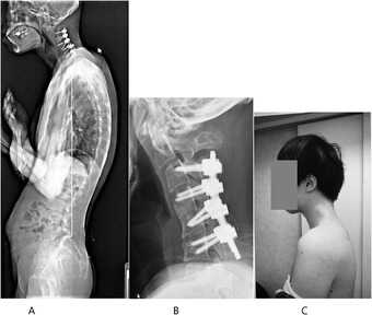 Standing spine x-ray 6 months after surgery