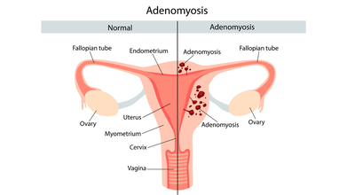 Adenomyosis