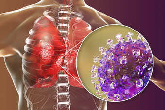 Nipah virus outbreak in india: how it affects lungs