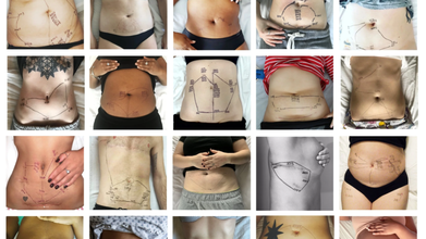 This is Endometriosis