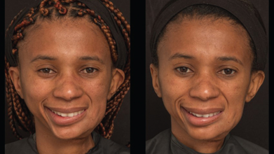 Can Botox Fix Asymmetrical Face?