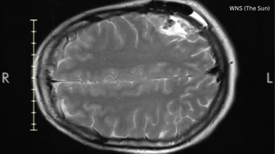 Lauren Macpherson Brushed Off Her Symptoms as ADHD, Turns Out She Had Terminal Brain Cancer