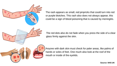 How do you recognize meningitis rash?