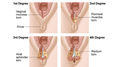 Degrees of Vaginal Tear