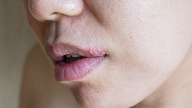 Shared Lipsticks, Makeup Items May Spread Herpes: Here’s How To Stay Safe
