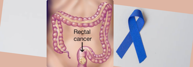 Rectal Cancer treatment