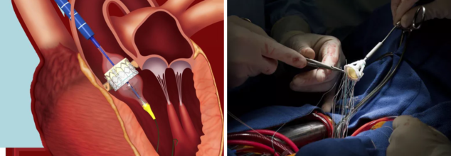 TAVR vs. SAVR