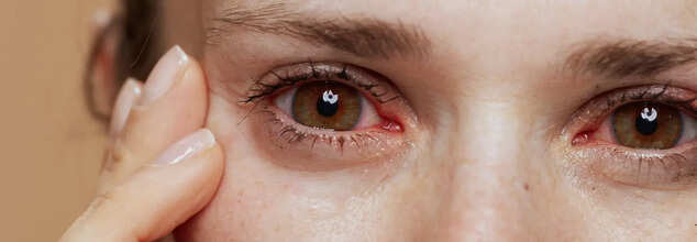 Eye Infection