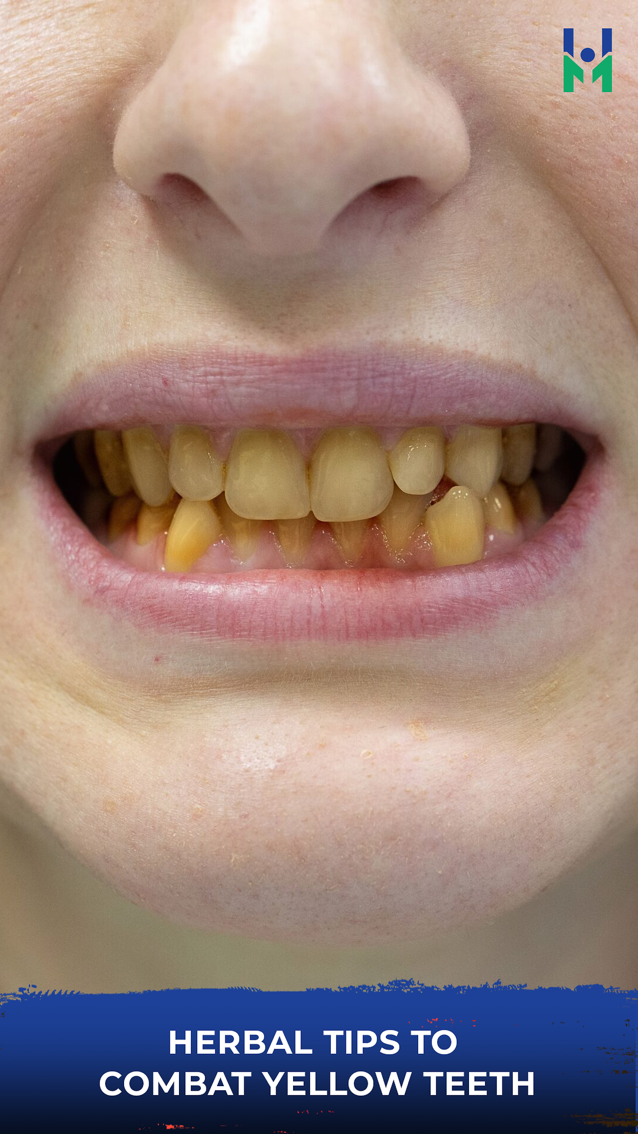 Herbal tips to combat yellow teeth