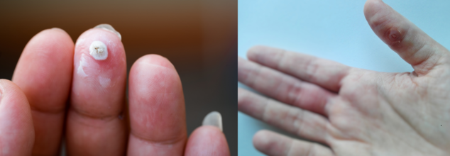Viral Wart