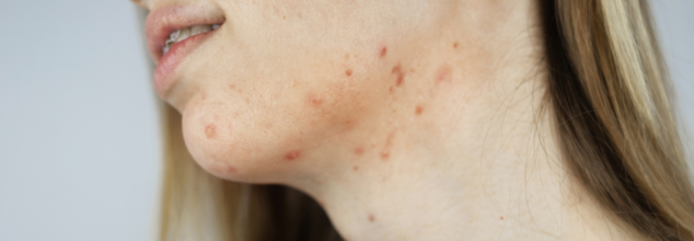 Neck Acne (Credit-Canva)