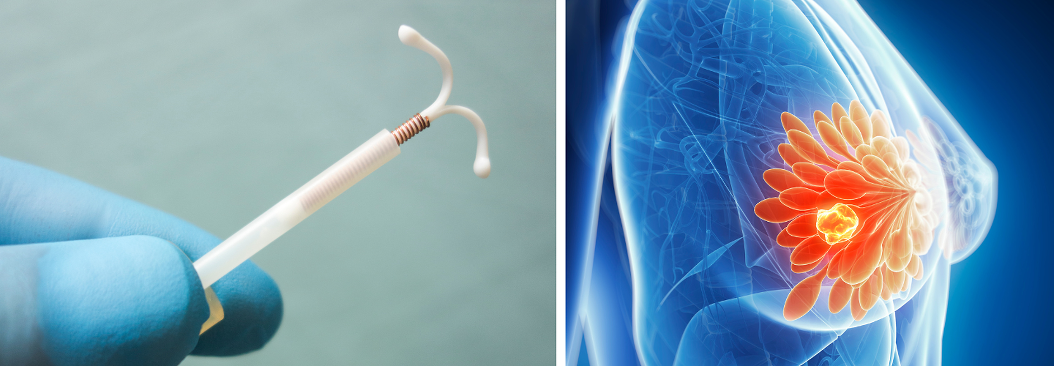Breast Cancer Awareness Month: The Link Between IUD And Breast Cancer ...