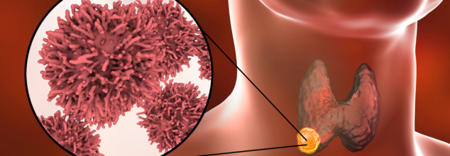 Throat Cancer
