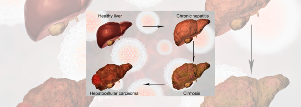 Liver Cancer