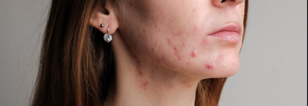 Winter Acne Triggers You Didn't Know About- Tips To Keep Your Skin Clear In The Cold