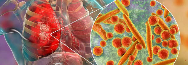 Pneumonia