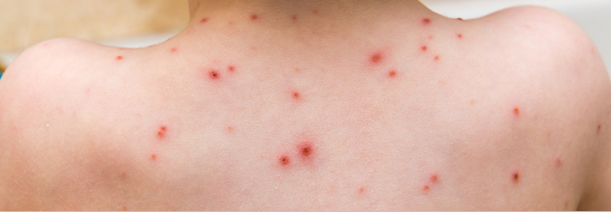 UK Reports New Case Of Mpox Variant Clade Ib- Is The Risk To UK Growing ...