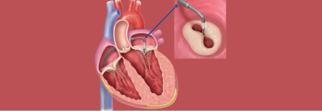 How Mitra-Clip is Changing the Game in Heart Treatment