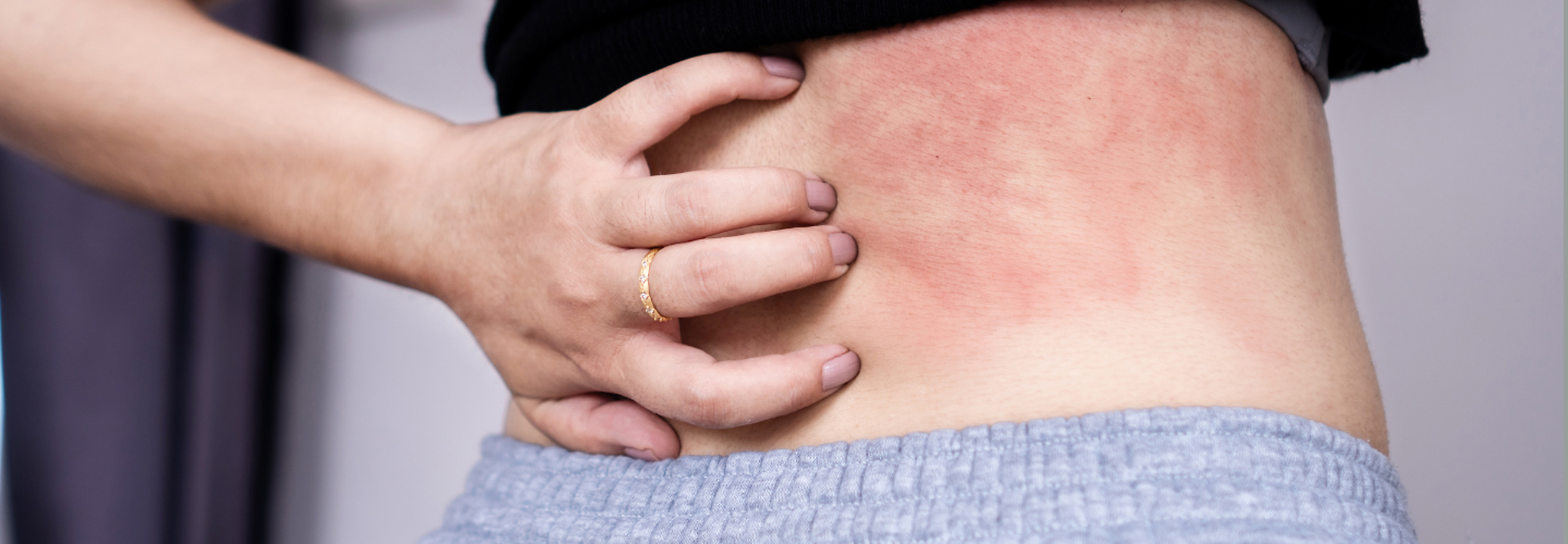 Skin Rash And Hives Could Be A Sign Of Stress- Here's What You Should ...