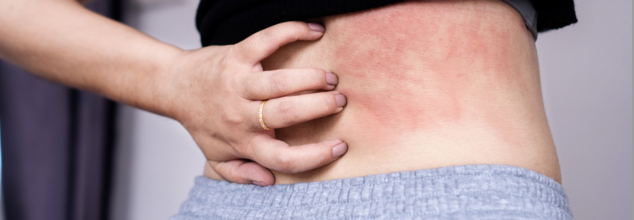 Skin Rash And Hives Could Be A Sign Of Stress- Here's What You Should Know