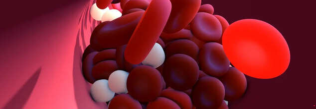 Blood Clot