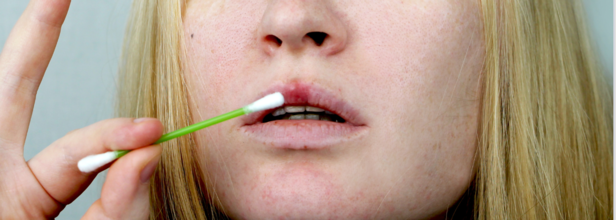 Syphilis Cases Rise To Record Highs Across US, CDC Reports Alarming Surge Since 1950s