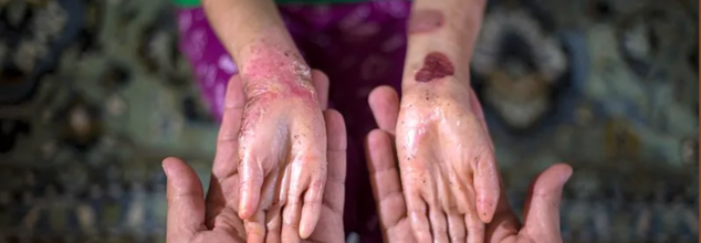 What Is 'Butterfly Disease'? The Rare Skin Disorder That Makes Skin As Fragile As Wings