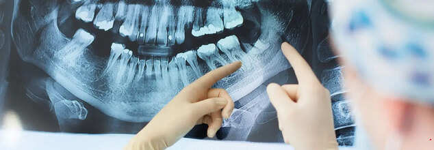 Dental X-Rays