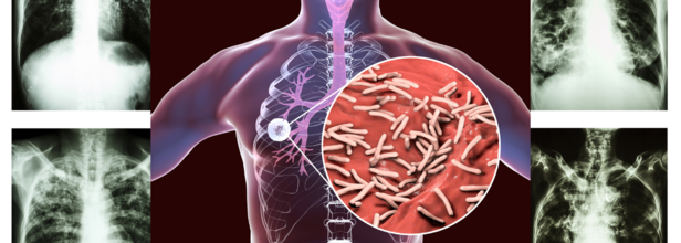 Tuberculosis Outbreak in Kansas