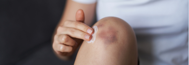 Random Bruising After Workout? Your Body Has 1 Of These 5 Things