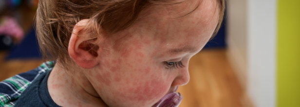 Measles