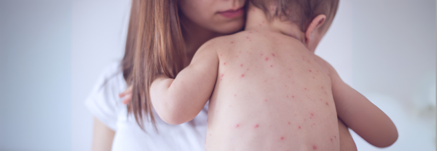 Measles Outbreak In Texas Among Children: Symptoms In Infants All Parents Must To Watch For