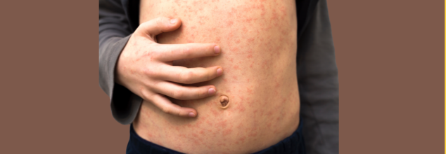 Unvaccinated Child Dies As Measles Outbreak Spreads In West Texas- How To Keep Children Safe?