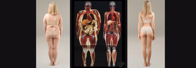 Obesity On The Inside: This Is What 250 lb vs. 125 lb Body Scan Reveals About Weight Loss And Health