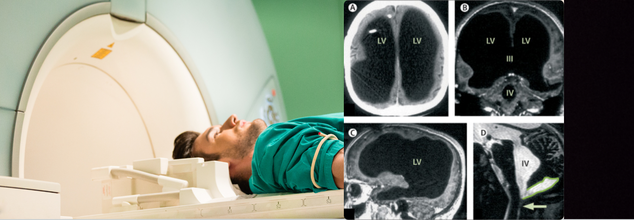 For This French Man, His Leg Weakness Turned Out To Be An Unexpected Rare Brain Abnormality-Diagnosed 44 Years Later!