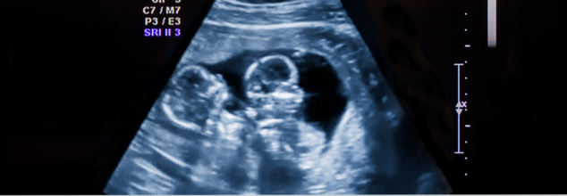 Your DNA Could Reveal If You Had A 'Vanishing Twin' In The Womb, With A Simple Test