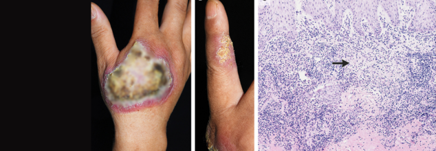 TB Usually Attacks The Lungs, But It Can Affect The Skin Too- 1.5% People Are Living With It
