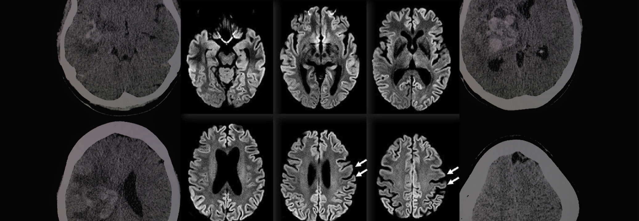 Rare 100% Deadly Brain Disease Kills Two In Oregon County, Third ...