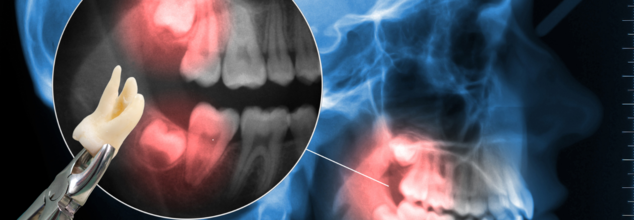 When Should You Get Your Wisdom Tooth Extracted?