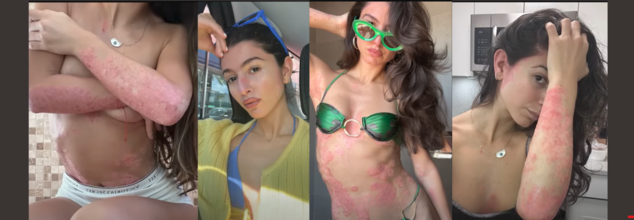 Diagnosed At 7, Bedridden At 25, This Woman’s Battle With A Chronic Skin Condition Led To Something Inspirational