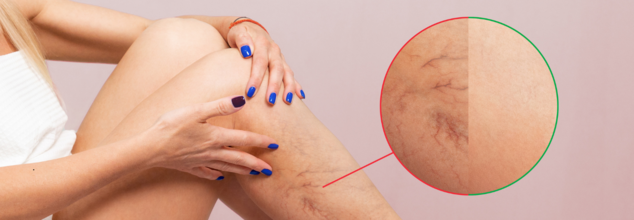 Varicose Veins Can Be Painful, What Can Be Done To Feel Relieved?