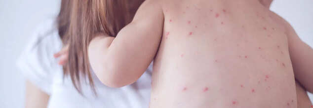 US Measles Cases Exceed 1,020 as RFK Jr Downplays Outbreaks